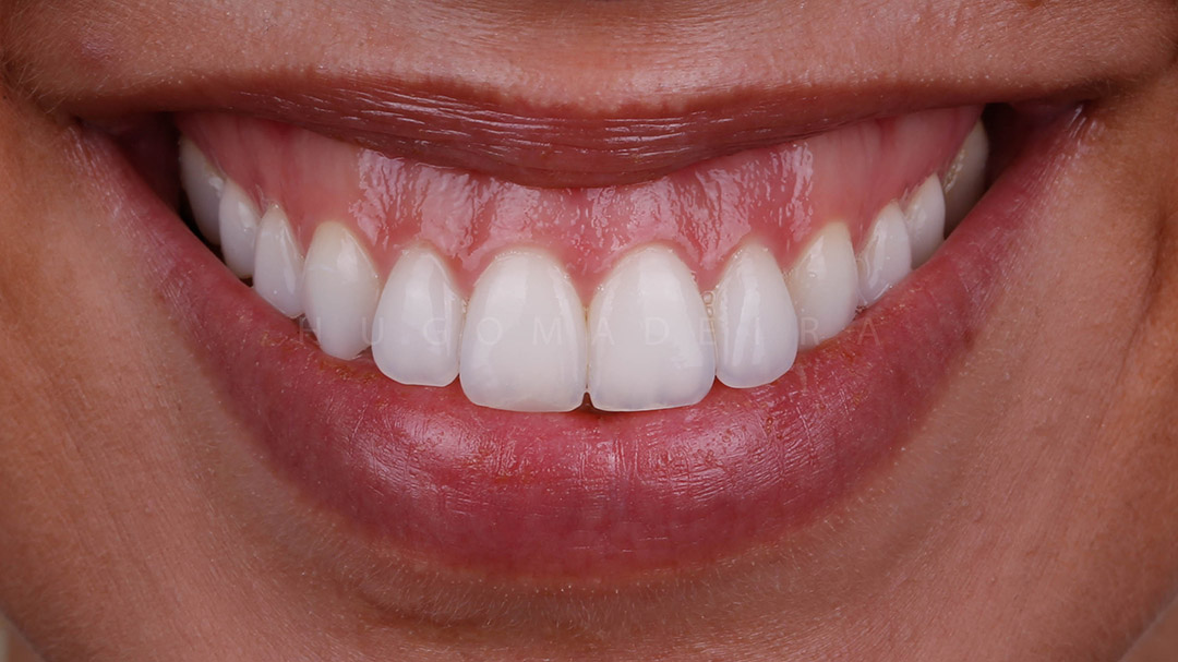 REGULARIZAÇÃO DE BORDOS INCISAIS