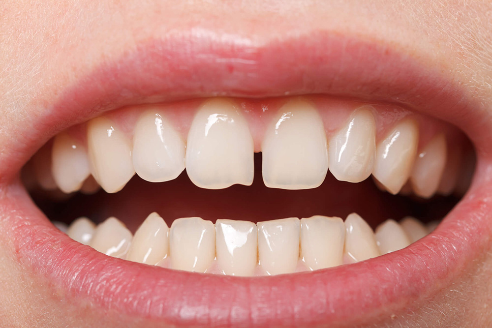 FECHAMENTO DE DIASTEMA